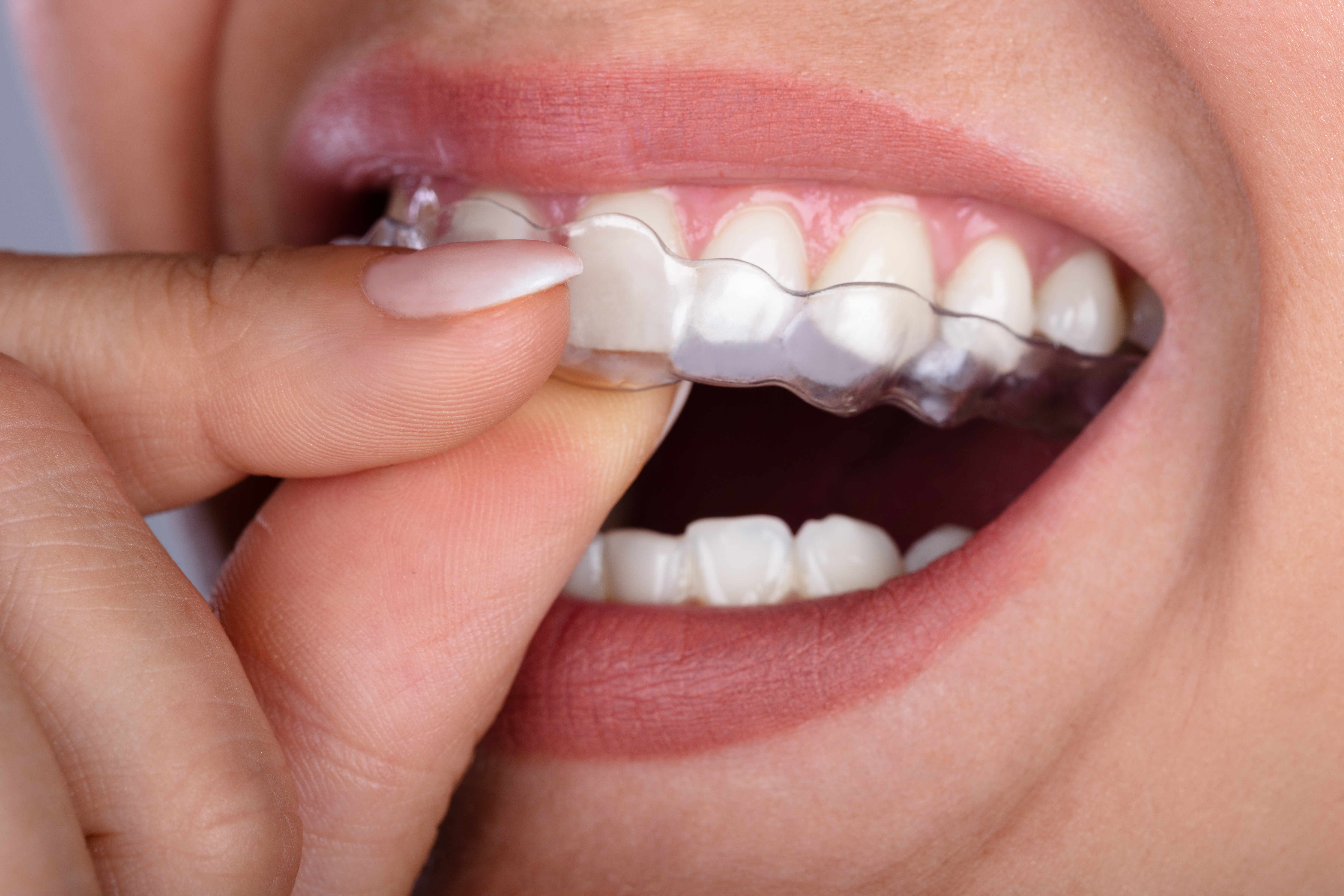 Clear Aligners in West Orange