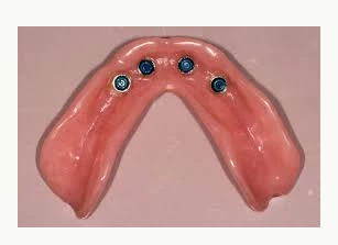 custom dentures