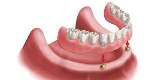 Dental Implants in West Orange
