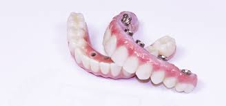 Dental Implants in West Orange