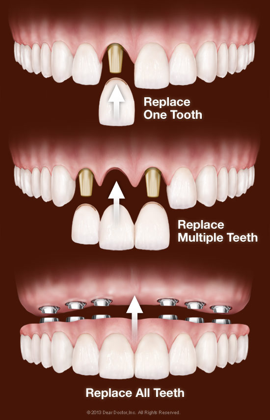 Dental Implants in West Orange