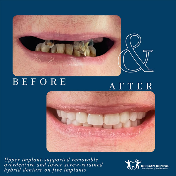 Deegan Dental | Intra-Oral Scanner, Dental Bridges and Preventative Program