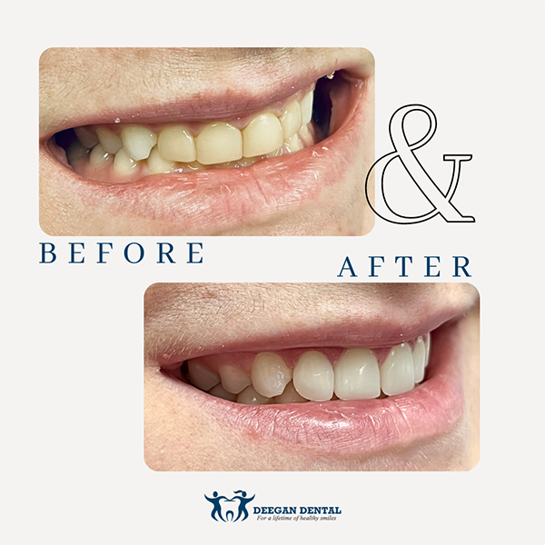 Deegan Dental | Botox reg , Laser Dentistry and Custom Dentures